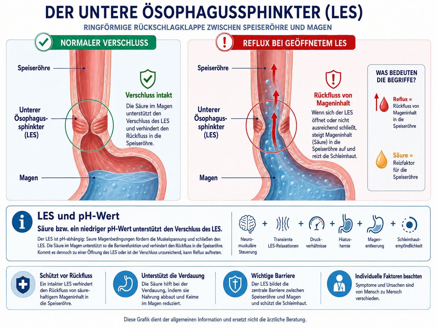 Medizinische Illustration des unteren Ösophagussphinkters LES als ringförmige Rückschlagklappe zwischen Speiseröhre und Magen, Darstellung von normalem Verschluss und Reflux bei geöffnetem LES, seriöse anatomische Infografik, klare Beschriftung, moderne Symphysio-Farbwelt